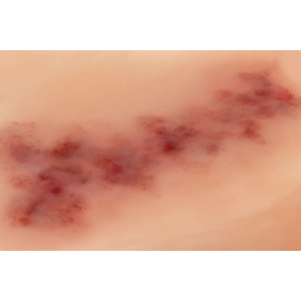 Wound Moulage "Hematoma Older" – Προσομοίωση Παλαιού Αιματώματος Wound Moulage "Hematoma Older" – Προσομοίωση Παλαιού Αιματώματος