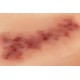 Wound Moulage "Hematoma Older" – Προσομοίωση Παλαιού Αιματώματος Wound Moulage "Hematoma Older" – Προσομοίωση Παλαιού Αιματώματος