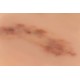 Wound Moulage "Fresh Hematoma" – Προσομοίωση Φρέσκου Αιματώματος Wound Moulage "Fresh Hematoma" – Προσομοίωση Φρέσκου Αιματώματος