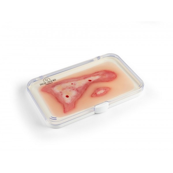 Wound Moulage "Scalding" – Προσομοίωση Εγκαύματος από Ζεστό Υγρό