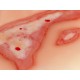 Wound Moulage "Scalding" – Προσομοίωση Εγκαύματος από Ζεστό Υγρό Wound Moulage "Scalding" – Προσομοίωση Εγκαύματος από Ζεστό Υγρό