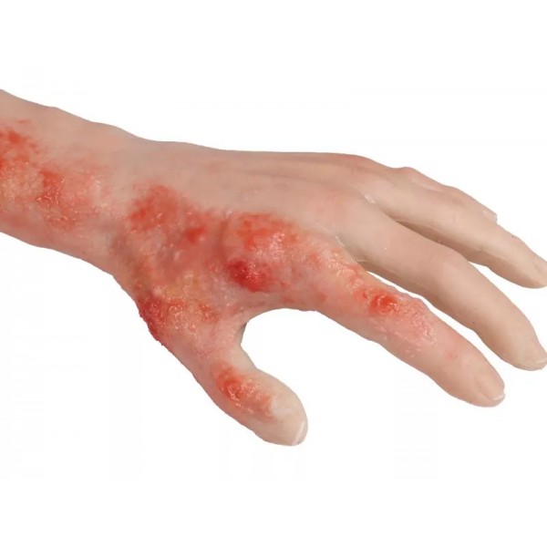 Arm with Burns Task Trainer – Εκπαιδευτικό Μοντέλο Χεριού με Εγκαύματα