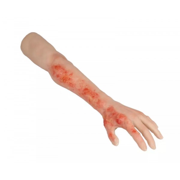 Arm with Burns Task Trainer – Εκπαιδευτικό Μοντέλο Χεριού με Εγκαύματα