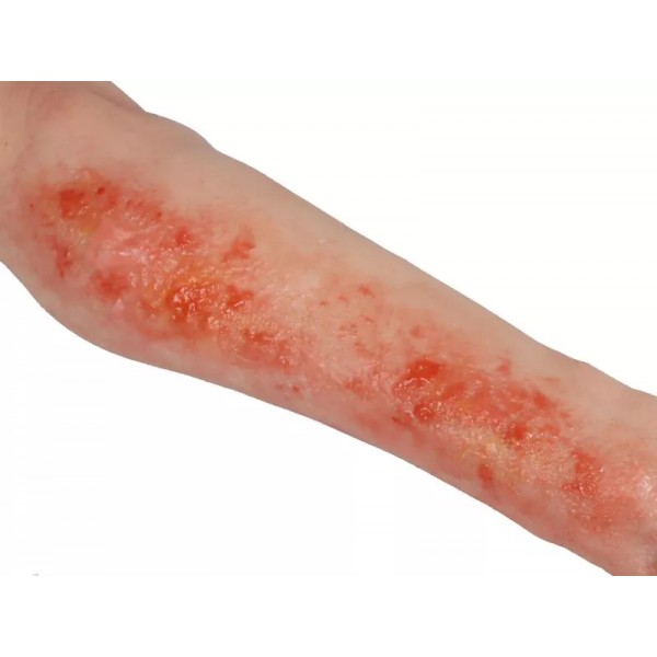 Arm with Burns Task Trainer – Εκπαιδευτικό Μοντέλο Χεριού με Εγκαύματα