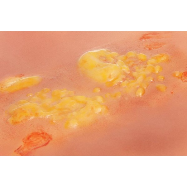 Wound Moulage "2nd Degree Burn" – Προσομοίωση Εγκαύματος 2ου Βαθμού