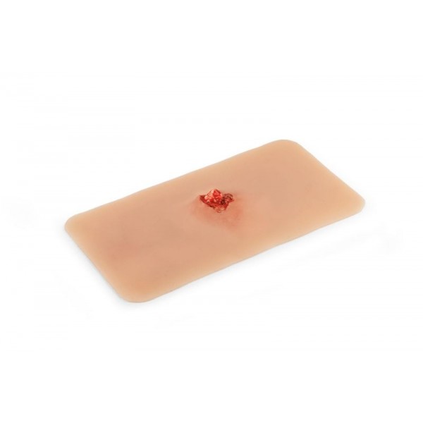 Wound Moulage – Ανοιχτό Κάταγμα Οστού Άνω Άκρου με Λειτουργία Αιμορραγίας Wound Moulage – Ανοιχτό Κάταγμα Οστού Άνω Άκρου με Λειτουργία Αιμορραγίας