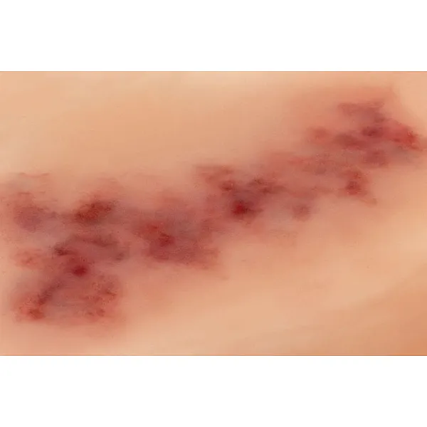 Wound Moulage "Hematoma Older" – Προσομοίωση Παλαιού Αιματώματος Wound Moulage "Hematoma Older" – Προσομοίωση Παλαιού Αιματώματος