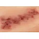 Wound Moulage "Hematoma Older" – Προσομοίωση Παλαιού Αιματώματος