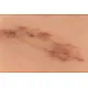 Wound Moulage "Fresh Hematoma" – Προσομοίωση Φρέσκου Αιματώματος Wound Moulage "Fresh Hematoma" – Προσομοίωση Φρέσκου Αιματώματος