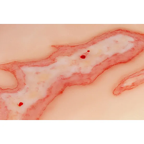 Wound Moulage "Scalding" – Προσομοίωση Εγκαύματος από Ζεστό Υγρό 2 Wound Moulage "Scalding" – Προσομοίωση Εγκαύματος από Ζεστό Υγρό 2