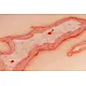Wound Moulage "Scalding" – Προσομοίωση Εγκαύματος από Ζεστό Υγρό 2