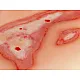 Wound Moulage "Scalding" – Προσομοίωση Εγκαύματος από Ζεστό Υγρό Wound Moulage "Scalding" – Προσομοίωση Εγκαύματος από Ζεστό Υγρό