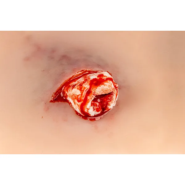 Wound Presentation "Open Fracture Ankle Joint" – Προσομοίωση Ανοικτού Κατάγματος στην Άρθρωση του Αστραγάλου Wound Presentation "Open Fracture Ankle Joint" – Προσομοίωση Ανοικτού Κατάγματος στην Άρθρωση του Αστραγάλου