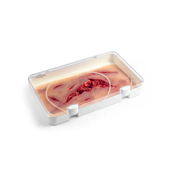 Wound Moulage – Μεγάλη Ρήξη Δέρματος με Λειτουργία Αιμορραγίας