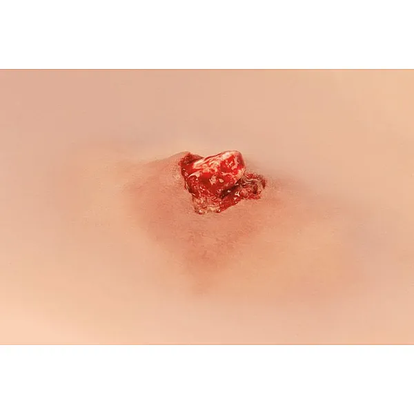 Wound Moulage – Ανοιχτό Κάταγμα Οστού Άνω Άκρου με Λειτουργία Αιμορραγίας Wound Moulage – Ανοιχτό Κάταγμα Οστού Άνω Άκρου με Λειτουργία Αιμορραγίας