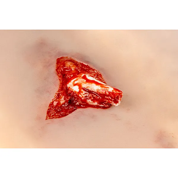 Wound Moulage – Ανοιχτό Κάταγμα Ποδιού με Λειτουργία Αιμορραγίας