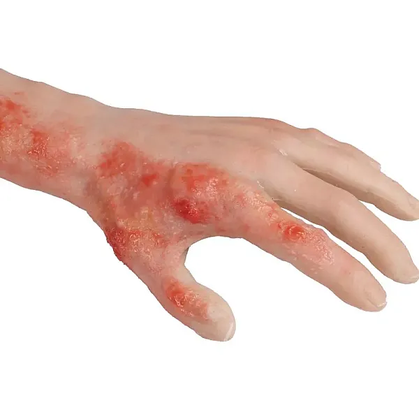 Arm with Burns Task Trainer – Εκπαιδευτικό Μοντέλο Χεριού με Εγκαύματα Arm with Burns Task Trainer – Εκπαιδευτικό Μοντέλο Χεριού με Εγκαύματα