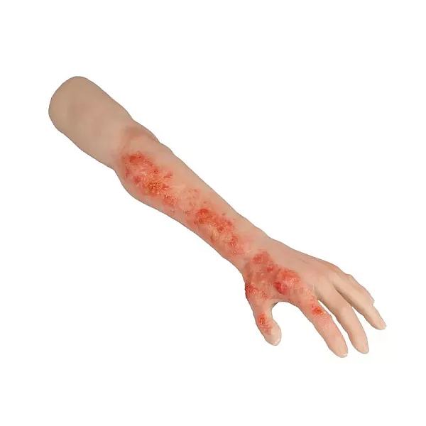 Arm with Burns Task Trainer – Εκπαιδευτικό Μοντέλο Χεριού με Εγκαύματα