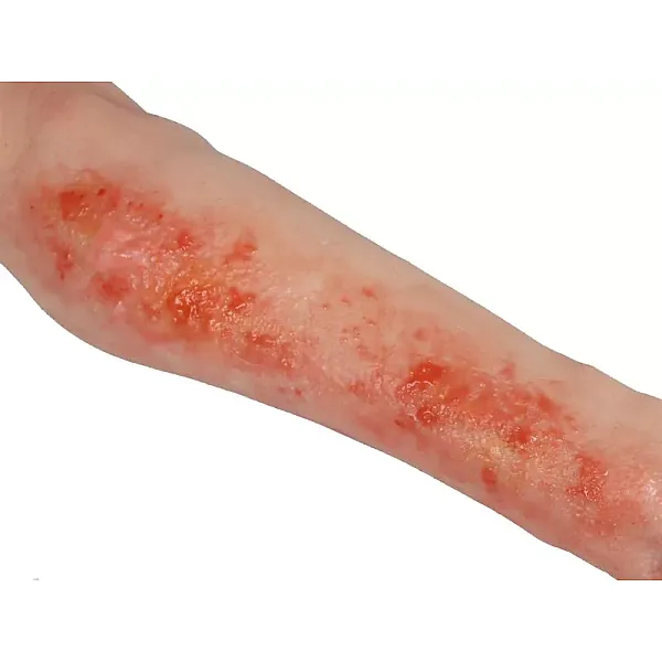 Arm with Burns Task Trainer – Εκπαιδευτικό Μοντέλο Χεριού με Εγκαύματα Arm with Burns Task Trainer – Εκπαιδευτικό Μοντέλο Χεριού με Εγκαύματα