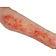 Arm with Burns Task Trainer – Εκπαιδευτικό Μοντέλο Χεριού με Εγκαύματα Arm with Burns Task Trainer – Εκπαιδευτικό Μοντέλο Χεριού με Εγκαύματα